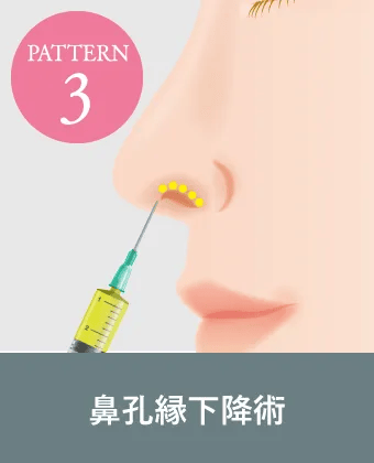 鼻孔縁下降術