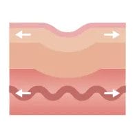 溝の奥にヒアルロン酸を注入し、シワを奥から持ち上げます。