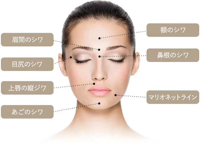ボトックス注入の適応部位