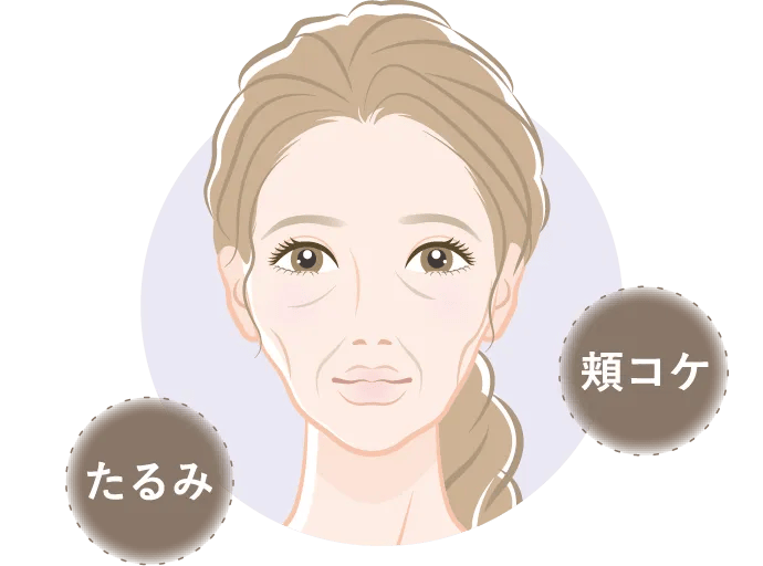 たるみと頬コケがあるタイプ