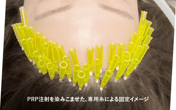 頭皮再生が進むにつれ、さらに引き上がる