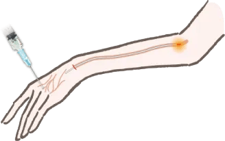 「ハンドスクレロセラピー」＋「レーザー治療」のコンビネーション