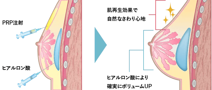 PRPハートヒアル注射