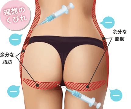 pスリム注射/脂肪を溶解