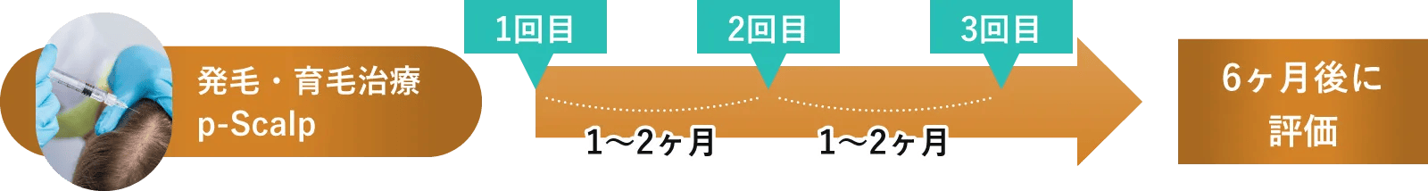 ピー・スカルプ治療スケジュール例：モデルプラン