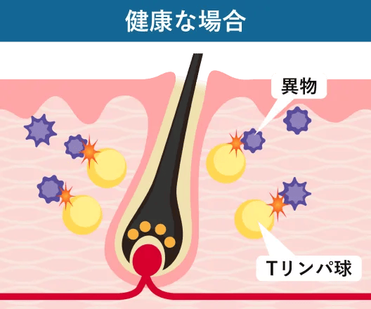 自己免疫反応はなぜ起きる？