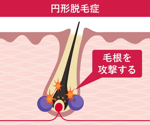 自己免疫反応はなぜ起きる？
