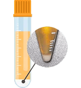 成長因子を含んだ血小板（当院作製）