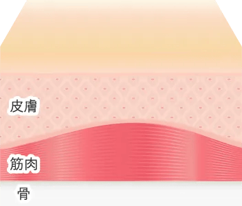 PRP注射による治療