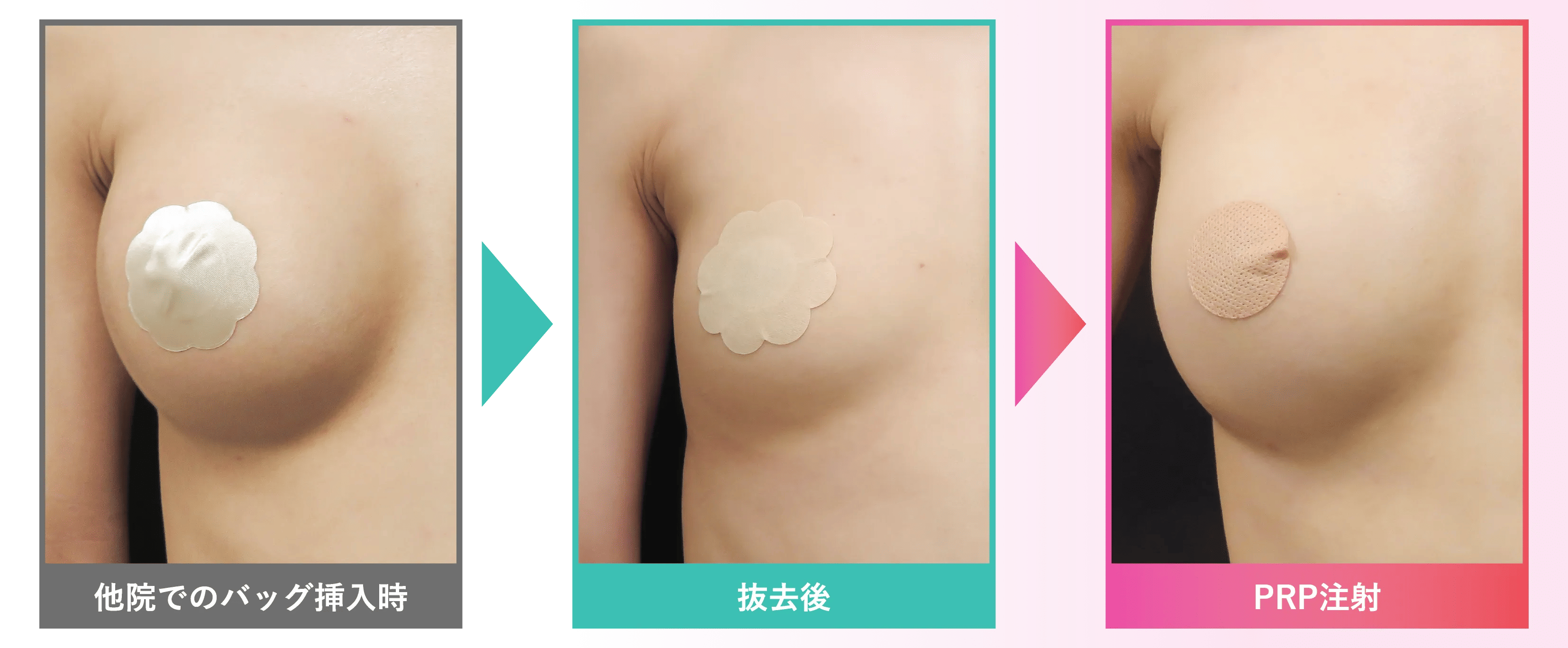 抜去後のPRP注入 安心