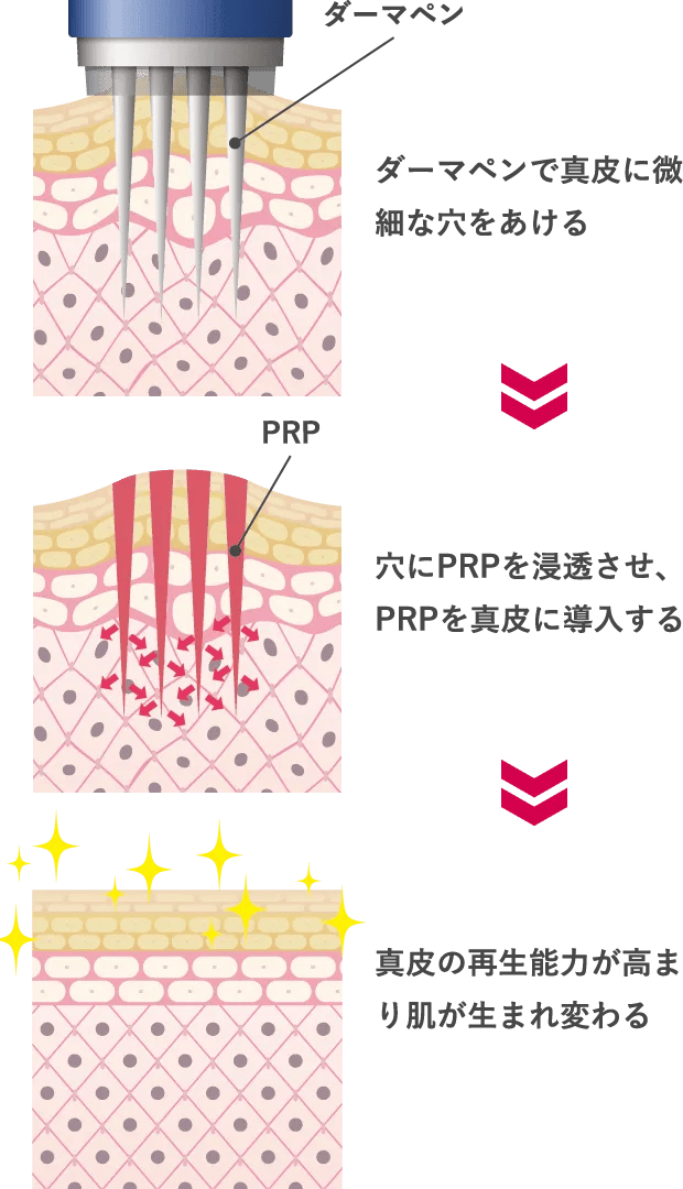 PRPが真皮にダイレクトに届く
