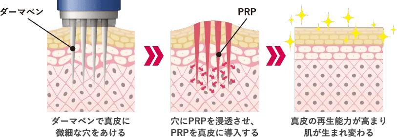 PRPが真皮にダイレクトに届く