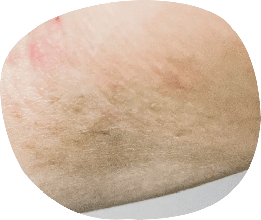 くすみ、色素沈着