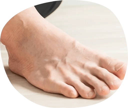 スジが浮いている