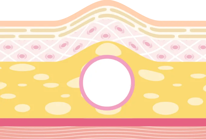 皮下脂肪が少ない