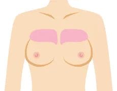 デコルテのごつごつ感を無くしたい