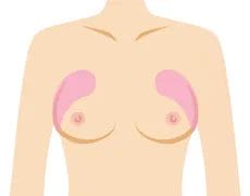 上胸ワキ側のそげを改善したい