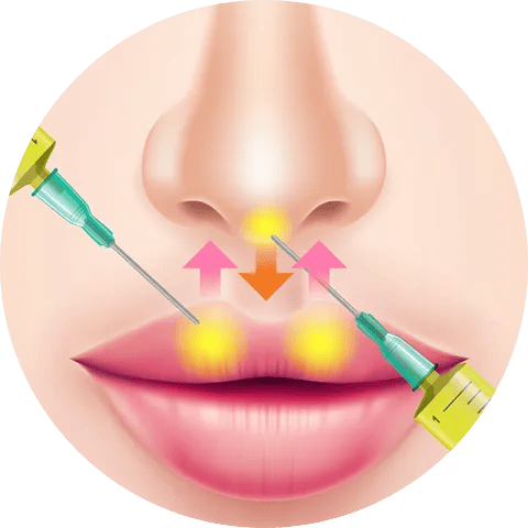 PRP注射注入部位
