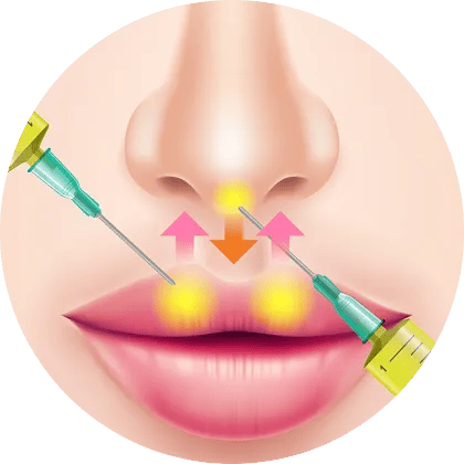 PRP注射注入部位