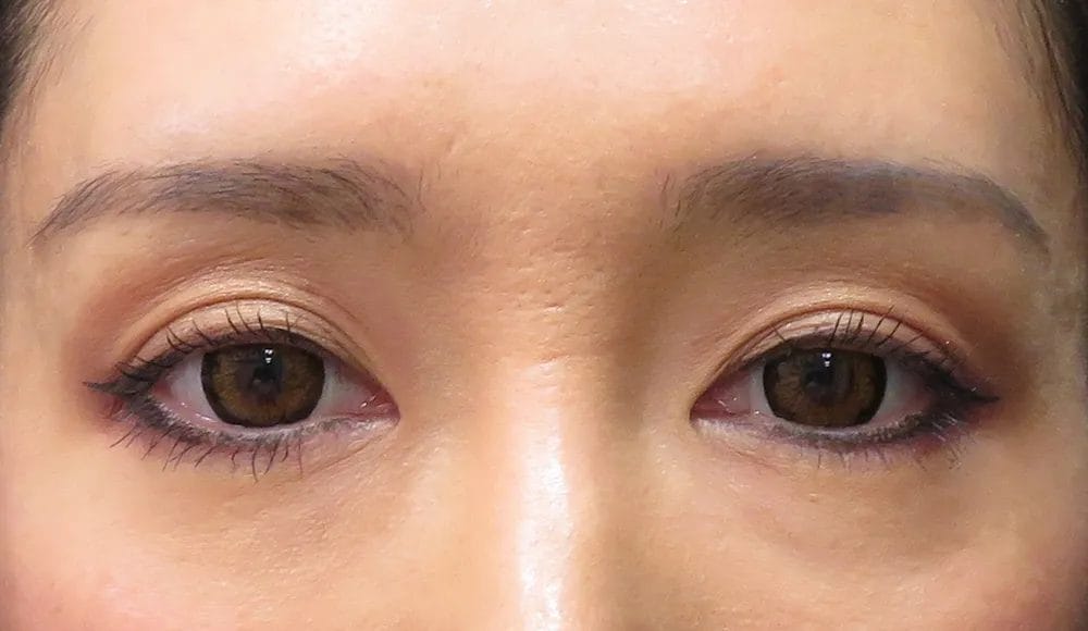 肌細胞の再生により皮膚がふっくら改善。くすみも解消