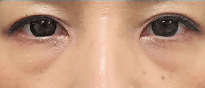 目の下にメラニン色素の沈着や角質が厚くなっている状態。