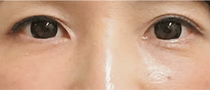 美肌効果により色素沈着が改善し、透明感のある肌質になる。