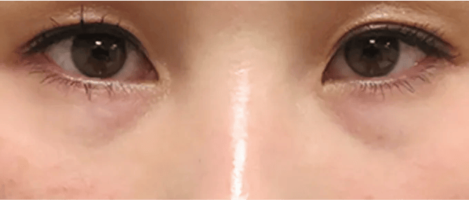 目の下の皮膚が薄く透けて血液が見えている状態。