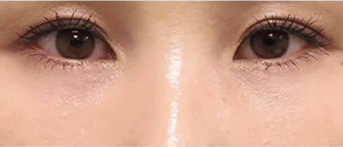 肌細胞の産生作用により、皮膚の厚みが正常化し、青みが改善する。