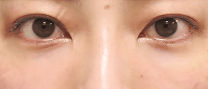 影の原因となる凹みを、脱脂術と肌再生効果の相乗効果でクマを改善。