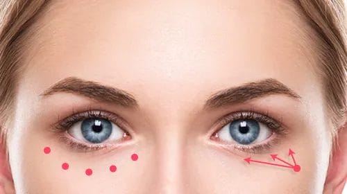 マジック・ニードルは、針先が丸くて細いから痛くない。