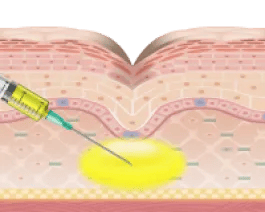 凹みやくすみの部分にPRPを注入