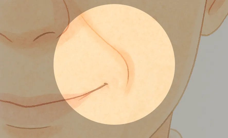 ほうれい線改善 Before