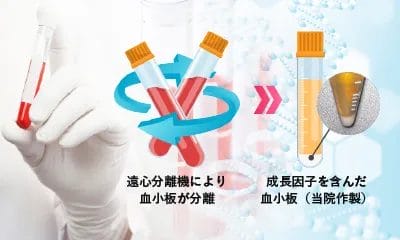 独自のPRP作製技術