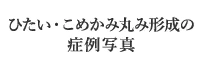 おでこPRP注射の症例