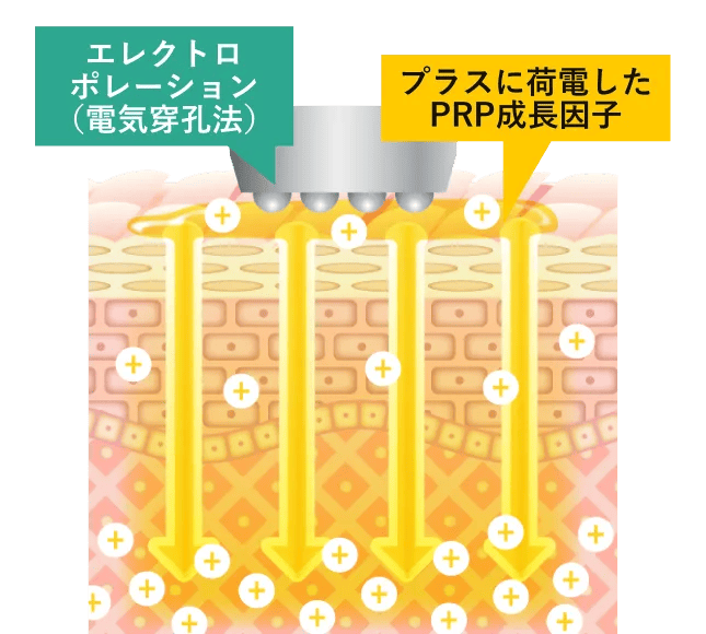 エレクトロポレーションで、一時的にできた角質孔からPRP注射液を電気的に真皮深層までデリバリー