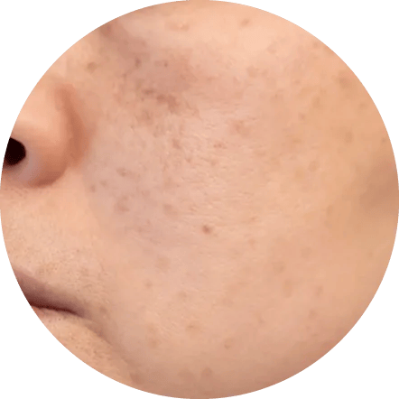 シワ・シミ・くすみ・ニキビ跡を改善したい