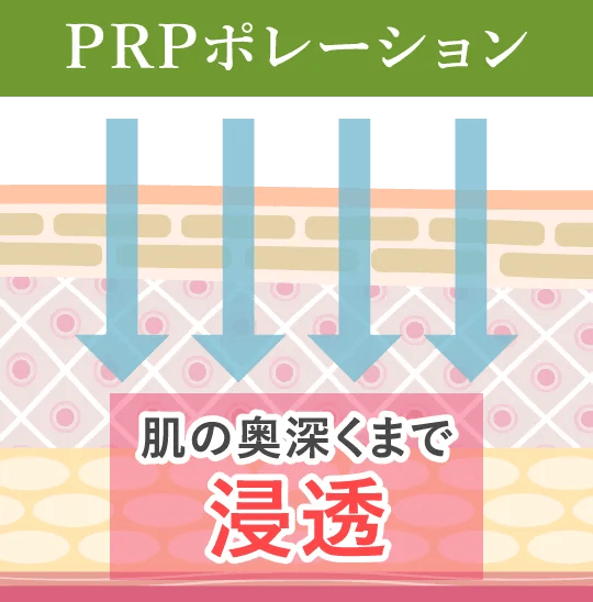 PRPポレーション