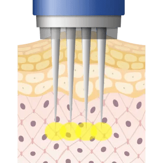 吸引しながら注入するため、しっかり深層部に届きます