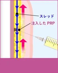 スレッドで引き上げた状態でPRPを注入