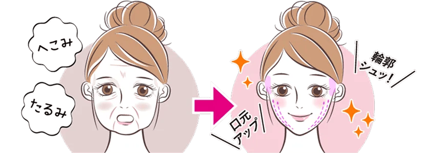 複合治療で深い凹みや脂肪によるたるみも同時に改善
