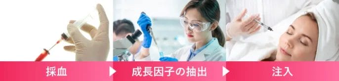 採血➡成長因子の抽出➡注入