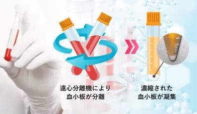 PRPがとにかく濃い！