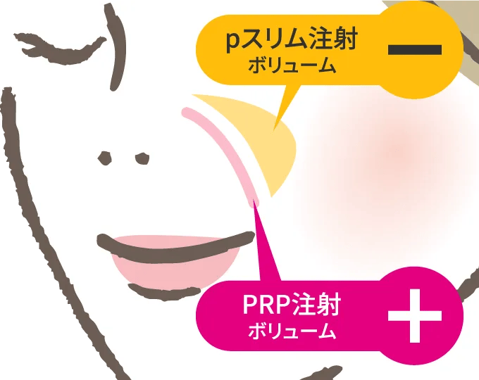 PRP注射施術部位：ほうれい線