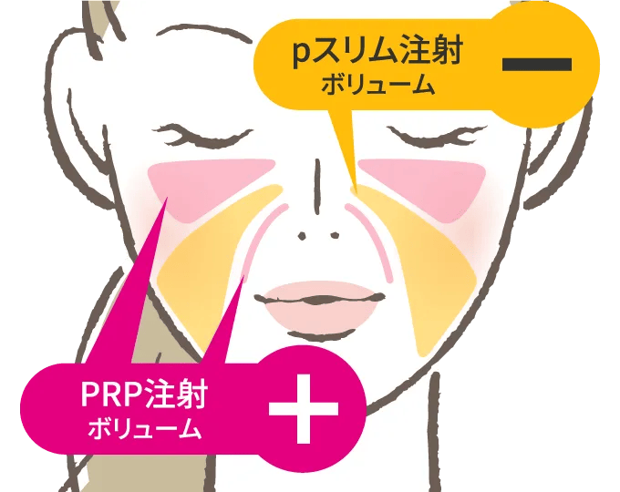 PRP注射施術部位：目の下、ほうれい線