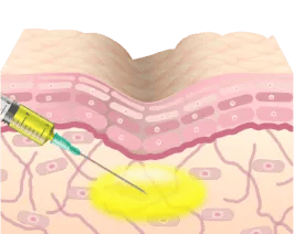 凹みやくすみの部分にPRPを注入