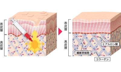 持続効果は5年以上！