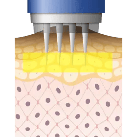 水光注射で黒ずみ部分にPRPを注入