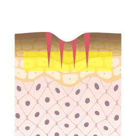 注射孔にミラノピールを浸透