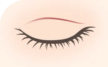 切開線が目立つ