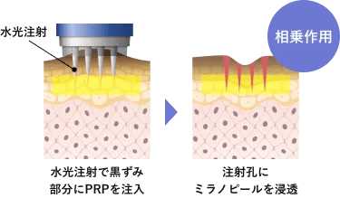 水光注射で黒ずみ部分にPRPを注入⇒注射孔にミラノピールを浸透